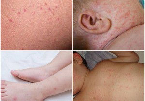 SỐT XUẤT HUYẾT Ở TRẺ EM VÀ NHỮNG ĐIỀU CẦN LƯU Ý