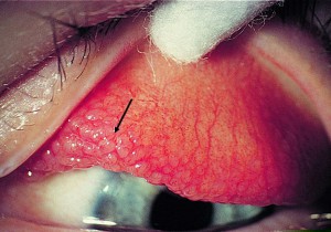 VIÊM KẾT MẠC MÙA XUÂN : NGUYÊN NHÂN VÀ CÁCH PHÒNG BỆNH