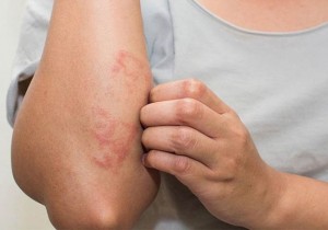 NHỮNG ĐIỀU CẦN BIẾT VỀ VIÊM DA CƠ ĐỊA