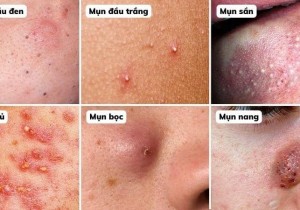 MỤN TRỨNG CÁ