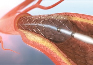 Thông báo về việc mời chào giá các mặt hàng VTYT dùng trong DSA tại Bệnh viện đa khoa khu vực miền núi phía Bắc Quảng Nam