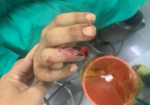 NHÂN MỘT TRƯỜNG HỢP VẾT THƯƠNG ĐẦU XA NGÓN TAY