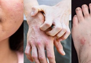 Bệnh lý về da khi trời lạnh và cách phòng tránh