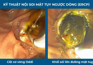 NHỮNG ĐIỀU CẦN BIẾT VỀ NỘI SOI MẬT TUỴ NGƯỢC DÒNG (ERCP)