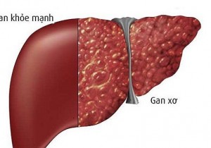 Bệnh lý xơ gan