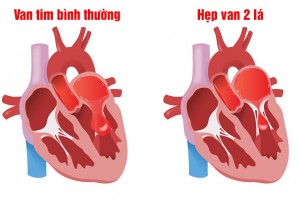 Tìm hiểu về Bệnh lý Hẹp van 2 lá