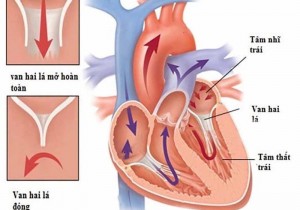 Những Điều Cần Biết Về HỞ VAN HAI LÁ