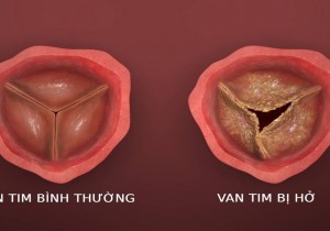 Những Điều Cần Biết Về HỞ VAN ĐỘNG MẠCH CHỦ