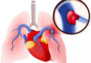 Những Điều Cần Biết Về Tăng Áp Động Mạch Phổi