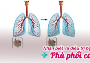 Nhận biết và điều trị Phù phổi cấp