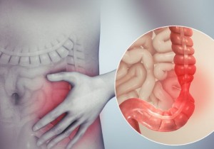 Hội Chứng Ruột Kích Thích (IBS)
