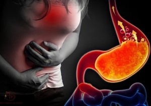 Trào Ngược Dạ Dày Thực Quản (GERD)