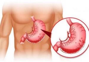 Cập nhật chẩn đoán và điều trị Bệnh lý Xuất huyết tiêu hoá