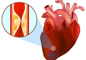 Nhồi máu cơ tim cấp cấp trên bệnh nhân viêm ruột thừa cấp nung mủ – báo cáo nhân một ca bệnh phức tạp