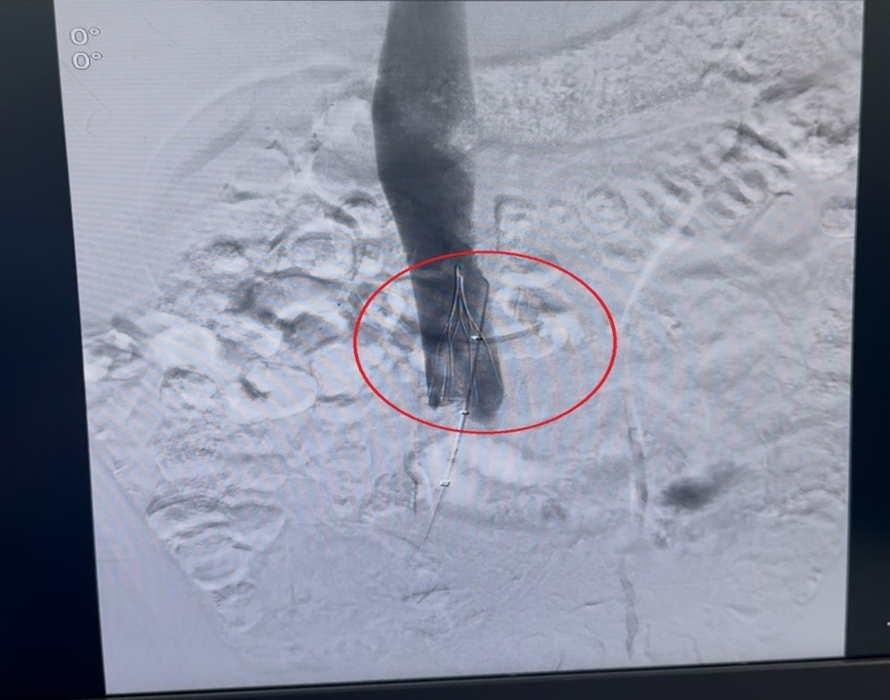 THỰC HIỆN THÀNH CÔNG KỸ THUẬT “ĐẶT LƯỚI LỌC TĨNH MẠCH CHỦ”